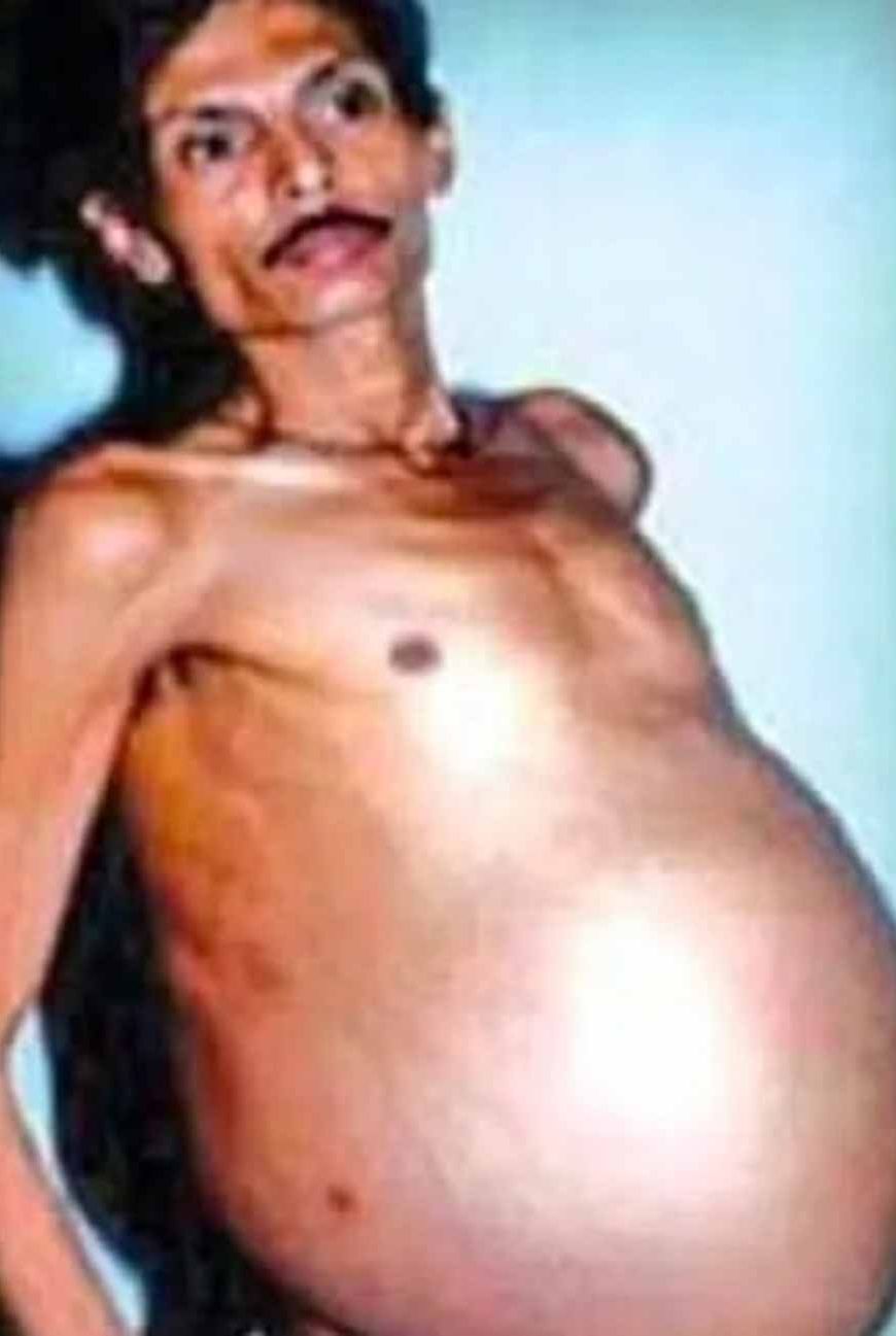 36 साल तक पेट में छिपे रहे जुड़वा भ्रूण, डॉक्टर भी रह गए हैरान
