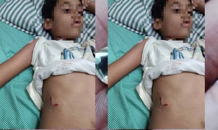 पेबल बे फेस 1, बागमुगलिया कटारा हिल्स में आवारा कुत्ते ने बच्चे को काटा