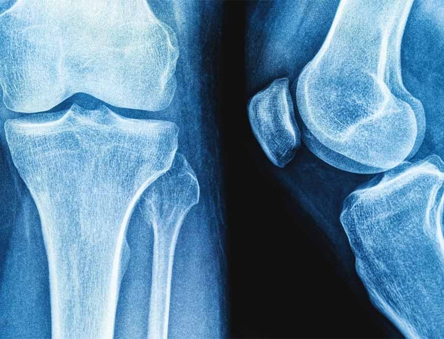 NIT की रिसर्च: हड्डियों की मरम्मत के लिए प्रोटीन से नए उपचार के रास्ते