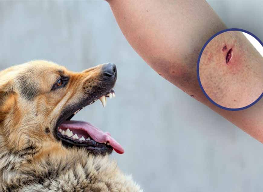 इंदौर में डॉग बाइट के मामले बढ़े, 7 महीने में 28,142 लोग बने शिकार