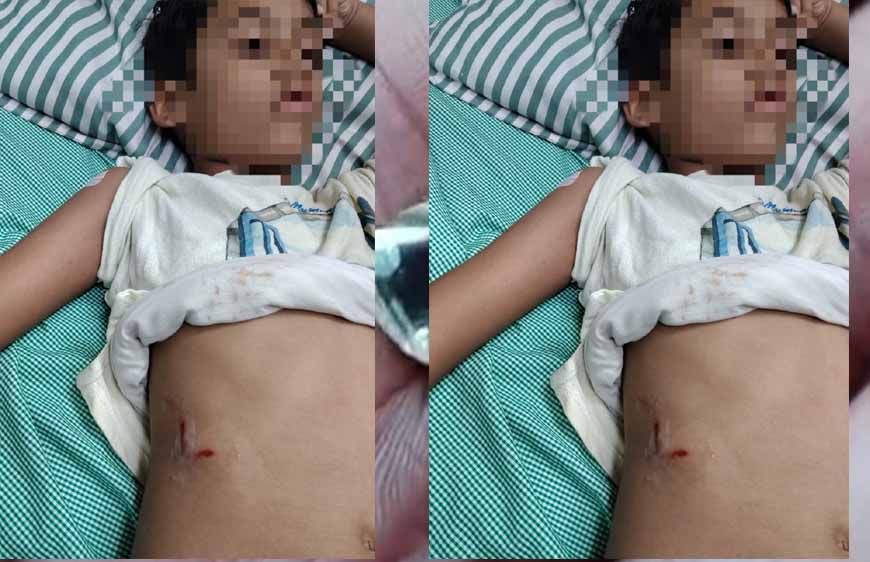 पेबल बे फेस 1, बागमुगलिया कटारा हिल्स में आवारा कुत्ते ने बच्चे को काटा