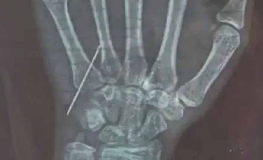 गोरखपुर में डॉक्टर की लापरवाही: 15 साल की बच्ची की नस में तोड़ा नीडल, CMO ने जांच के आदेश दिए