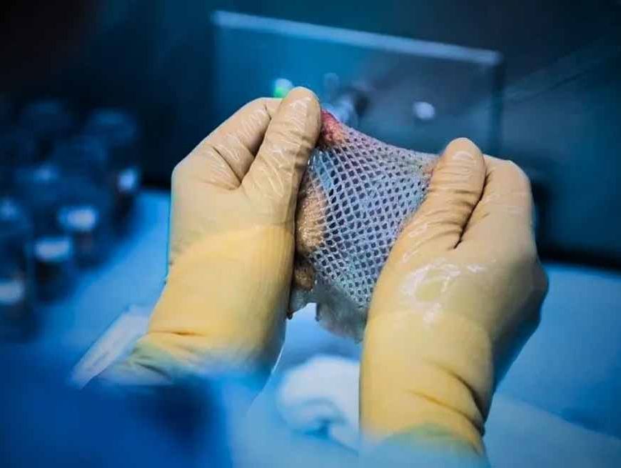 विन्ध्य क्षेत्र में पहली बार हुआ स्किन डोनेशन