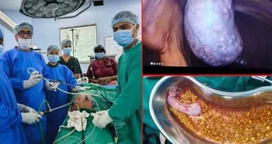 रांची के सदर अस्पताल में पहली बार बाएं गॉल ब्लैडर स्टोन की सफल सर्जरी, मरीज ने डॉक्टर को किया धन्यवाद