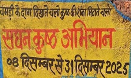 एमसीबी : सघन कुष्ठ खोज अभियान - घर-घर पहुंच रही स्वास्थ्य विभाग की टीम