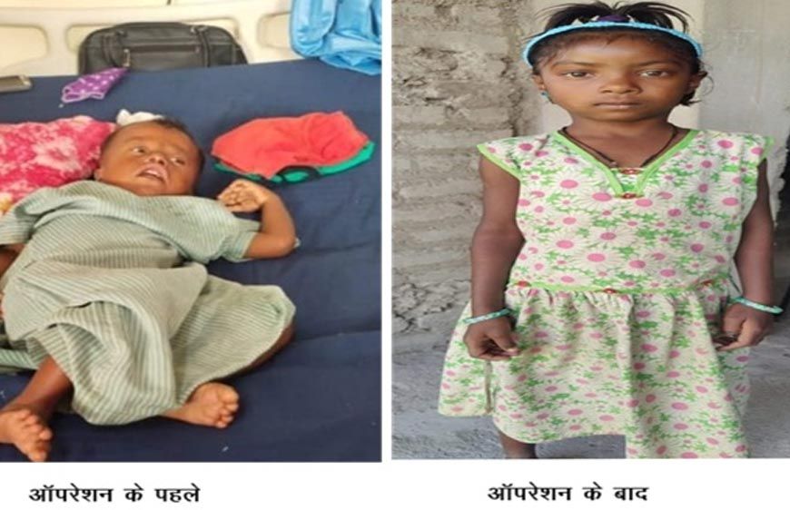 रायपुर : चिरायु योजना बच्चों के लिए भी बनी वरदान