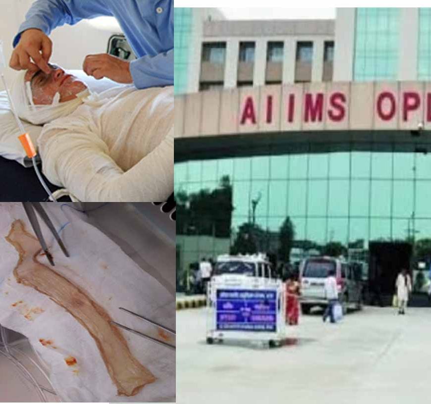 बिहार का पहला स्किन बैंक तैयार, पटना एम्स में जलने वाले मरीजों को अब मिलेगा नया जीवन