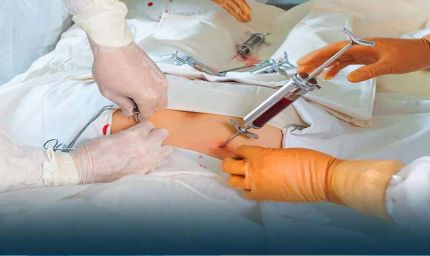 थैलीसीमिया मरीजों को राहत: निःशुल्क बोन मैरो ट्रांसप्लांट और 1250 रुपए मासिक पेंशन, बायोमेट्रिक जरूरी नहीं