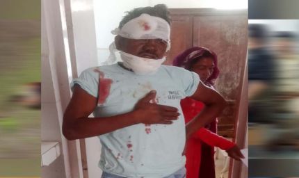 ब्रेकर में बाइक जैंपिंग होने से हादसा: चालक को आया गंभीर रूप से जख्म