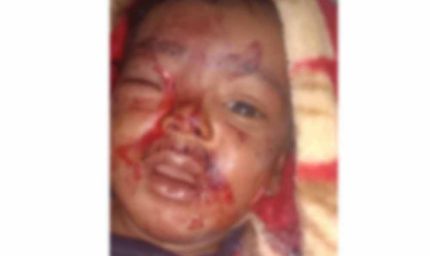 आंगन में खेल रहे 6 माह के मासूम को आवारा कुत्ते ने काटा, जिला अस्पताल में भर्ती