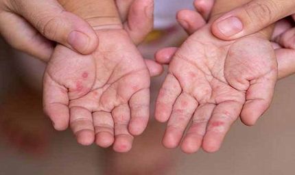 MP में खसरे की दस्तक: 4 जिलों में मिले 12 नए मरीज, स्वास्थ्य विभाग अलर्ट पर