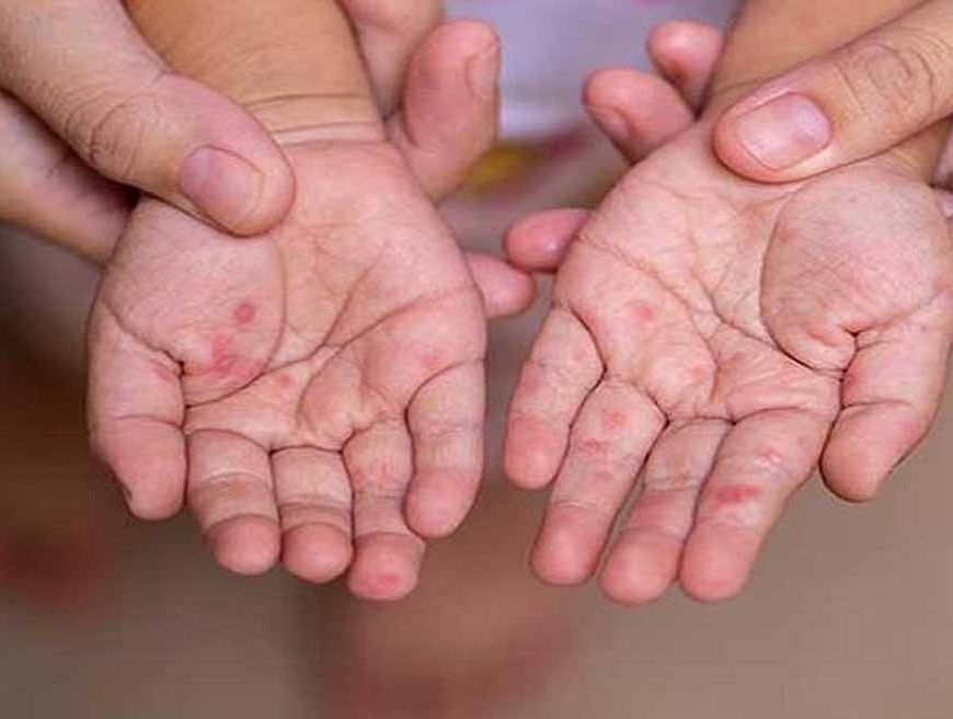 MP में खसरे की दस्तक: 4 जिलों में मिले 12 नए मरीज, स्वास्थ्य विभाग अलर्ट पर