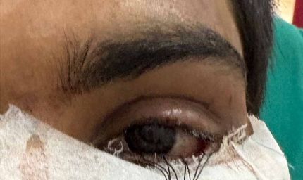 स्किन ग्राफ्टिंग से मरीज के पलक का सफल पुनर्निर्माण