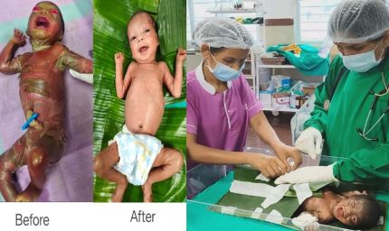 अत्यंत दुर्लभ बीमारी से जूझ रहे नवजात को बीजापुर जिला अस्पताल की SNCU में मिला नया जीवन