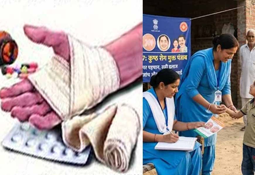 पंजाब में बढ़ी चिंता: कुष्ठ रोग के 352 एक्टिव केस, बच्चों में लक्षणों ने बढ़ाया खतरा