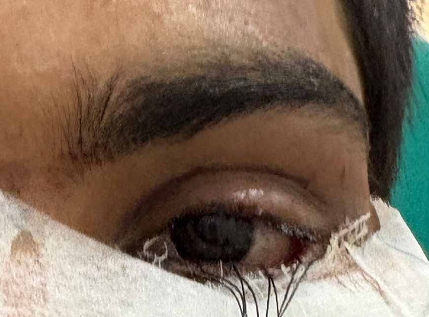 स्किन ग्राफ्टिंग से मरीज के पलक का सफल पुनर्निर्माण