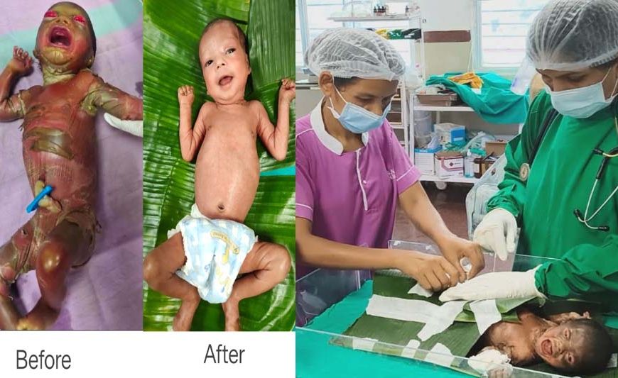 अत्यंत दुर्लभ बीमारी से जूझ रहे नवजात को बीजापुर जिला अस्पताल की SNCU में मिला नया जीवन