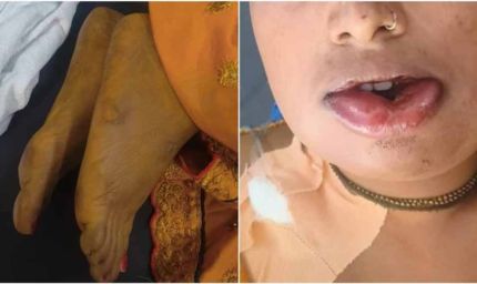 जहरीली हल्दी बनी जानलेवा! शादी से पहले उबटन लगाते ही दुल्हन की मौत