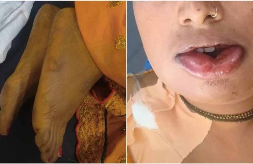 जहरीली हल्दी बनी जानलेवा! शादी से पहले उबटन लगाते ही दुल्हन की मौत