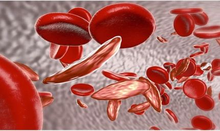 Sickle Cell Disease: देश के 59% मरीज ओडिशा और MP में मिले, 7.27 करोड़ लोगों की हुई जांच