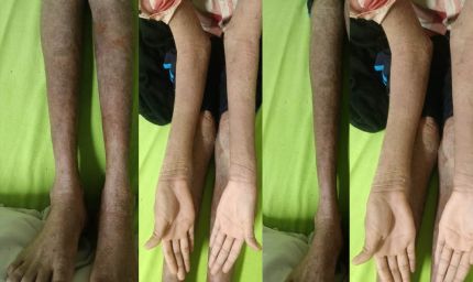 नामुमकिन हुआ मुमकिन, ‘लाइलाज’ समझी जा रही बीमारी का एम्स रायपुर में सफल उपचार