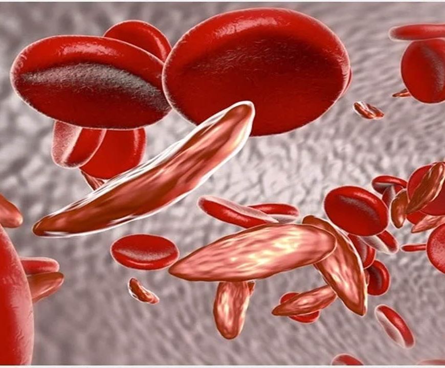 Sickle Cell Disease: देश के 59% मरीज ओडिशा और MP में मिले, 7.27 करोड़ लोगों की हुई जांच