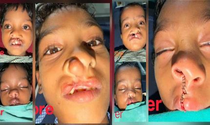 चिरायु योजना से जन्मजात समस्या से मिली राहत, तीन बच्चों के चेहरों पर लौटी मुस्कान