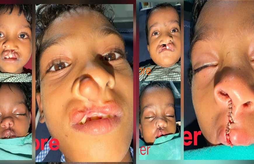 चिरायु योजना से जन्मजात समस्या से मिली राहत, तीन बच्चों के चेहरों पर लौटी मुस्कान