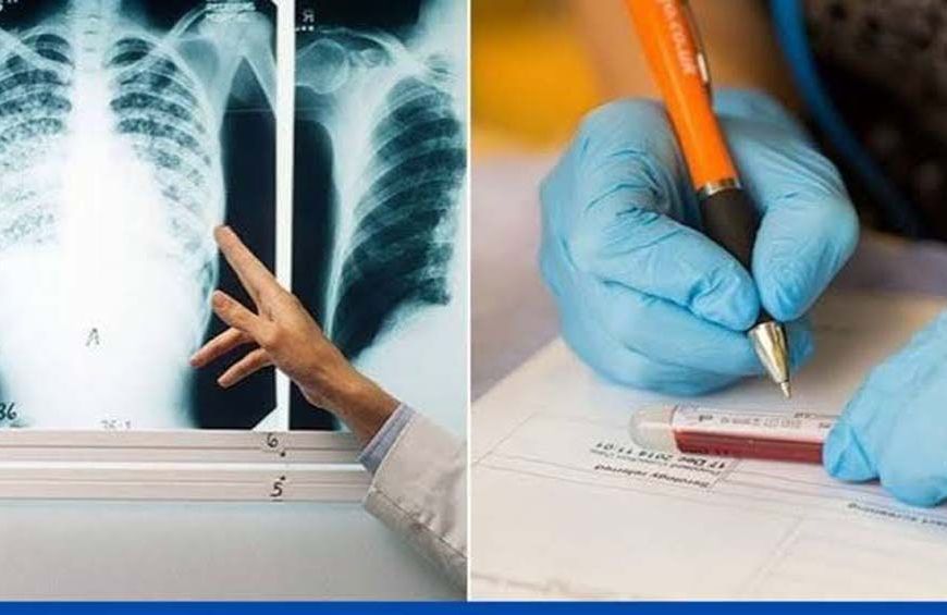 टीबी और छाती रोगों की जांच के लिए कैमोर में दो दिवसीय विशेष शिविर