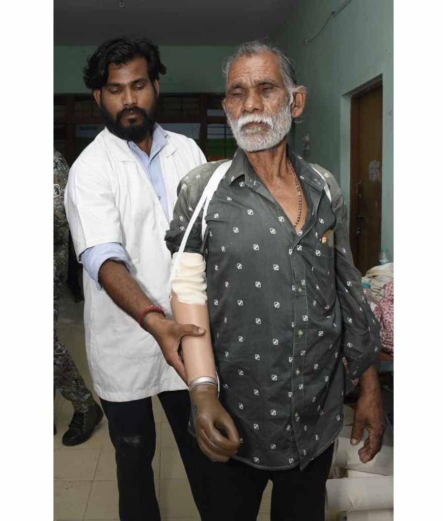 ट्रेन हादसे के दर्द पर 'सेवा संकल्प' का मरहम, धमतरी के तेजराम को दो घंटे में मिला कृत्रिम हाथ, लौटी जिंदगी की रंगत